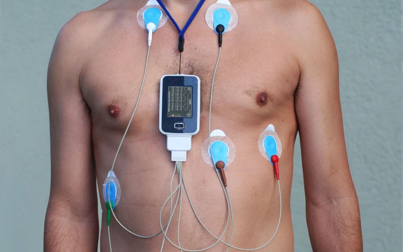Tórax de um paciente com eletrodos e o gravador do Holter 24h preso ao pescoço